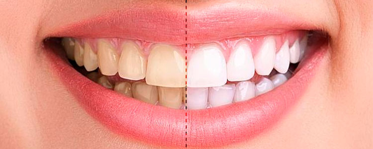 Blanqueamiento dental