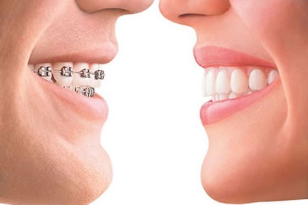 Invisalign
